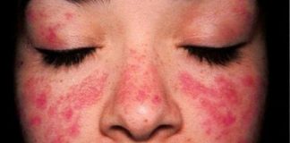 Dấu hiệu bệnh lupus ban đỏ