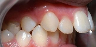 Có nên bọc sứ cho răng của bị hô