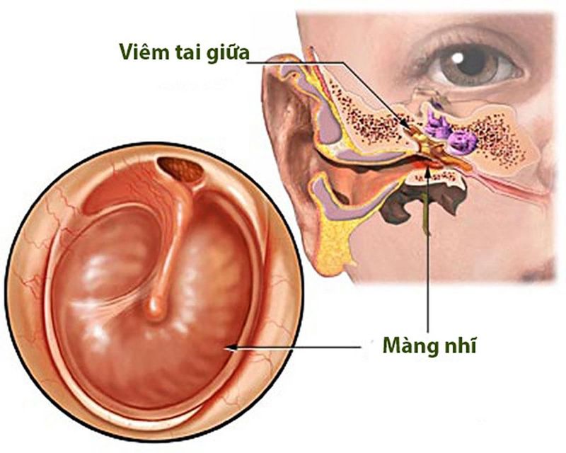 benh-viem-tai-giua-la-gi-2