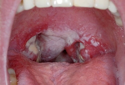 benh-lau-co-lay-qua-duong-mieng-khong-2