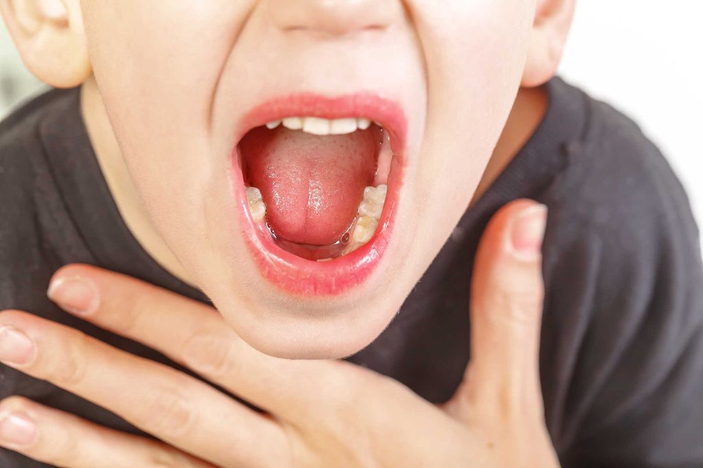 Tìm hiểu cách chữa viêm họng cho bé không dùng kháng sinh