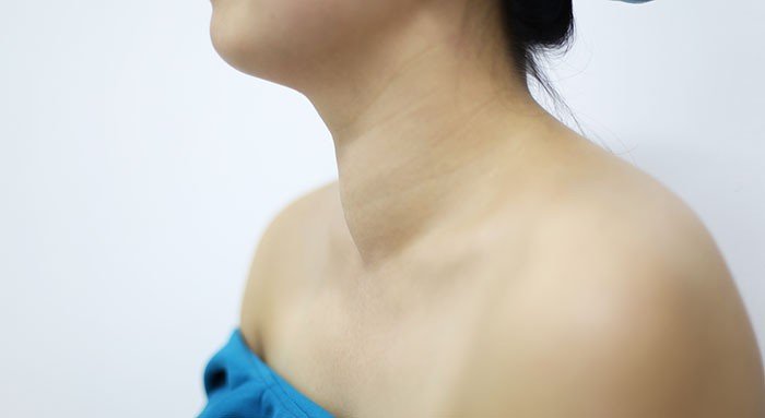 bướu cổ là gì